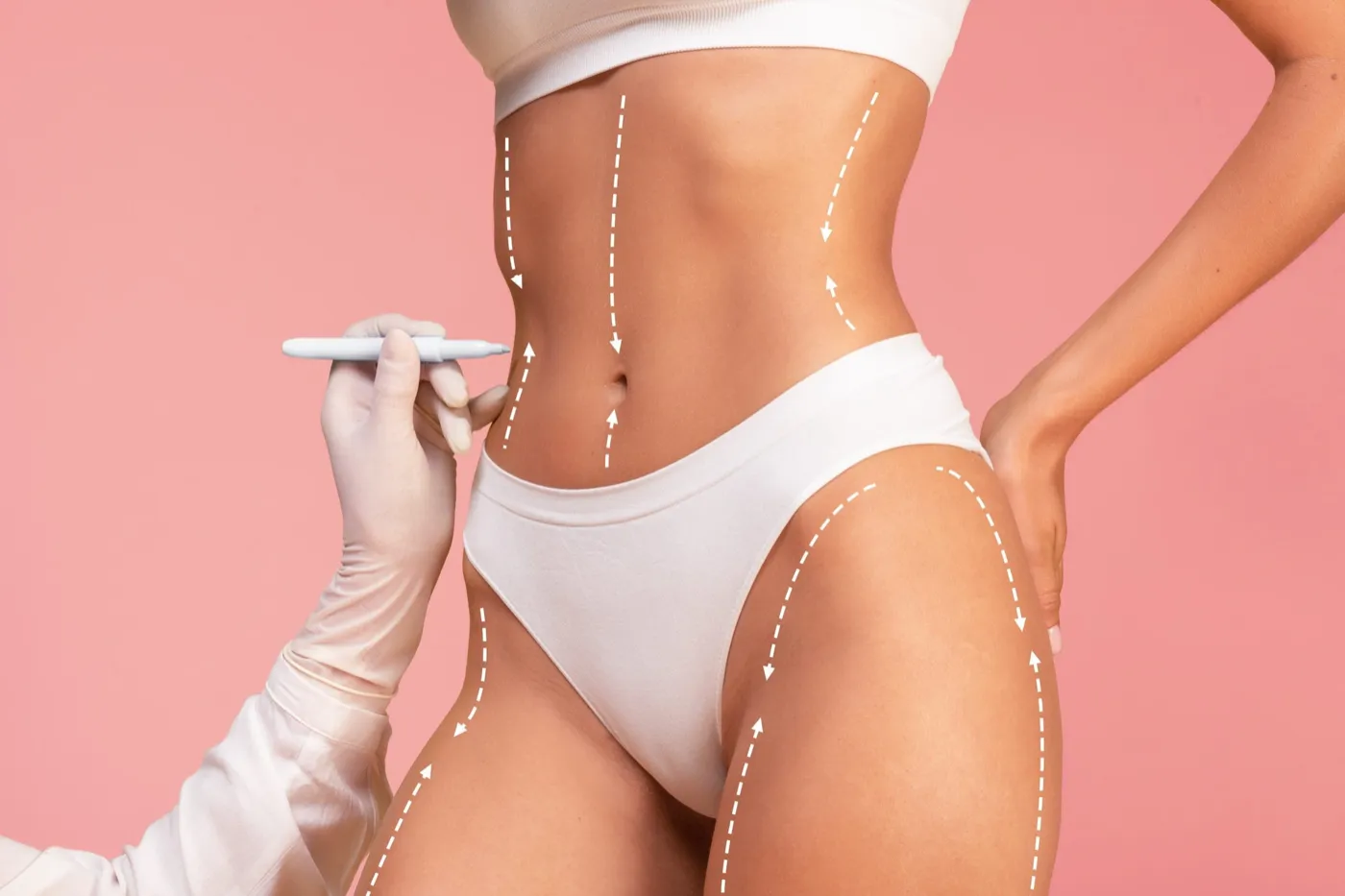 Garis penanda area tindakan pada model, ilustrasi bedah estetik