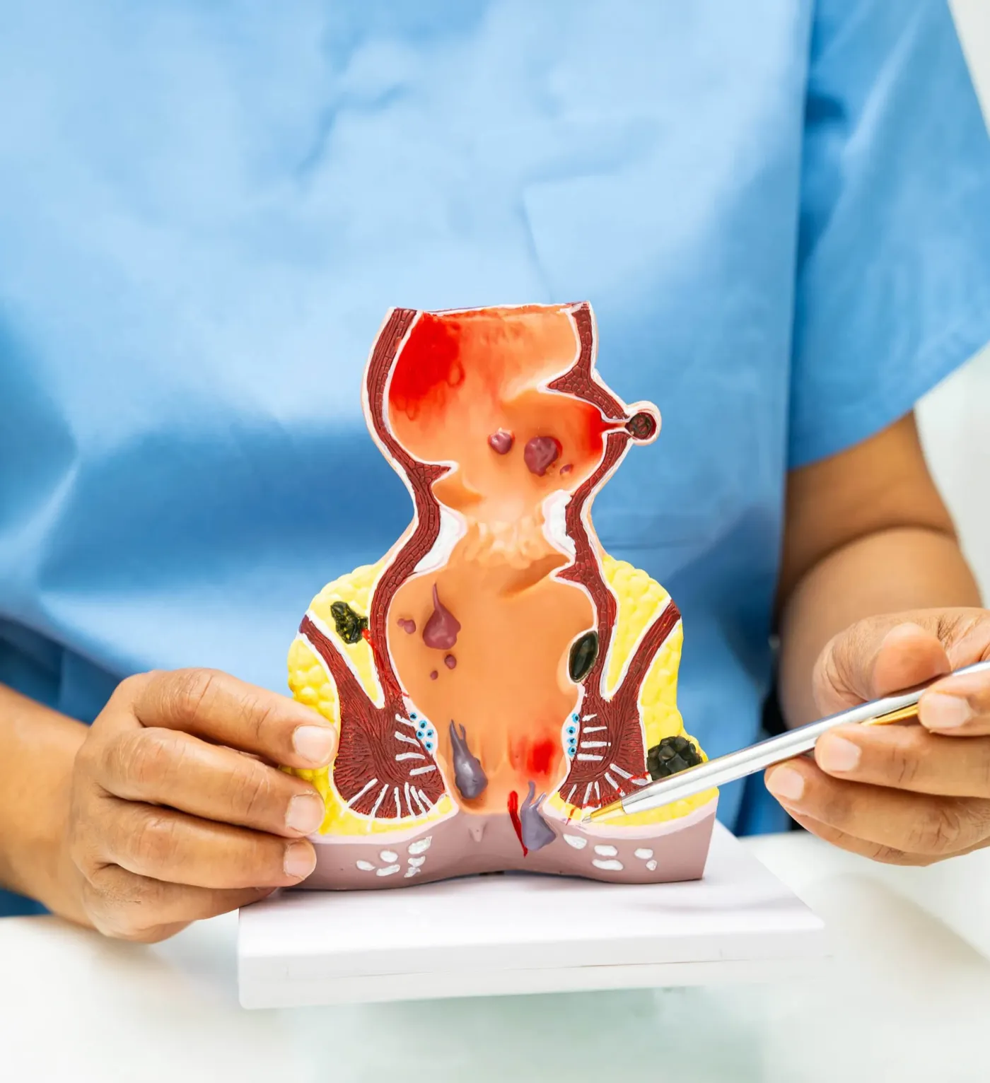 Dokter menjelaskan wasir dengan model anatomi