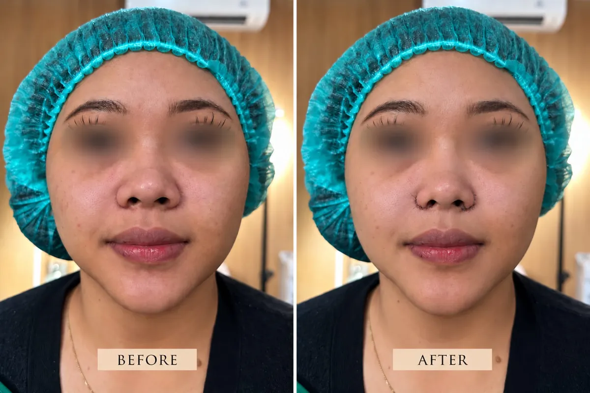 Foto sebelum dan sesudah Alarplasty (cuping hidung) pada pasien ME Clinic