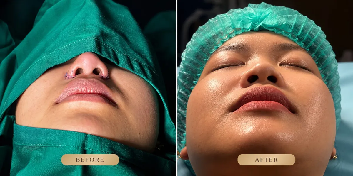 Foto sebelum dan sesudah Alarplasty (cuping hidung) pada pasien ME Clinic