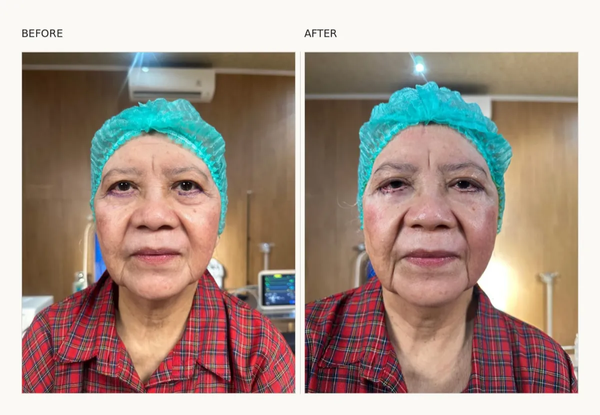 Foto sebelum dan sesudah Lower blepharoplasty (kelopak mata bawah) pada pasien ME Clinic
