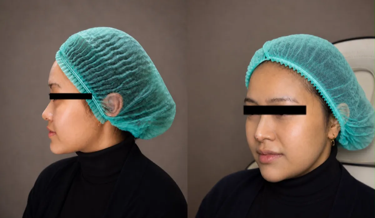 Foto sebelum dan sesudah Thread lift (hidung) pada pasien ME Clinic